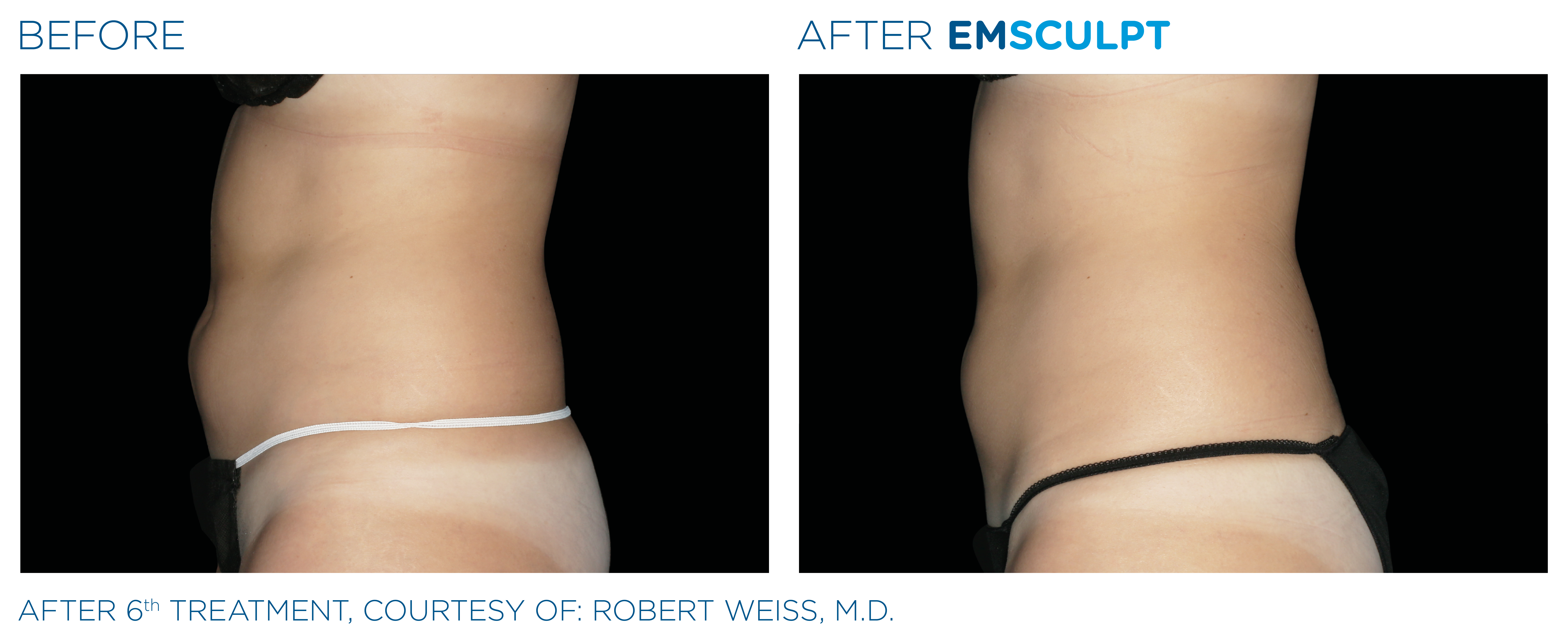 Emsculpt abdomen results - before and after